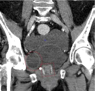 CT scan (coronal reconstruction) showing an AMS 800 in a woman