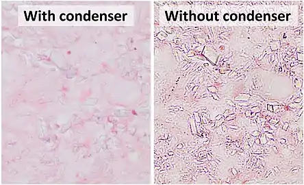 An example of a situation where microscopy without condenser is preferable at high magnification is the evaluation of crystals (calcium pyrophosphate dihydrate crystal deposition disease pictured).