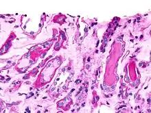 Micrograph showing myeloma cast nephropathy in a kidney biopsy: Hyaline casts are PAS positive (dark pink/red – right of image).  Myelomatous casts are PAS negative (pale pink – left of image), PAS stain.