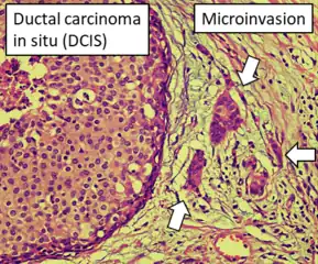 DCIS with microinvasion, defined as focus of invasive cancer measuring up to 1.0&nbsp;mm in size.