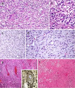 Spindle cell variant of papillary thyroid carcinoma (PTC) showing spindle cells with typical PTC nuclei (a and b). Meningioma-like follicular adenoma (c and d), the typical arrangement of spindle to ovoid cells in a whorled pattern may give the impression one is dealing with a vascular tumor. Pericytic-like follicular adenoma (e) is characterized by a proliferation of spindle follicular cells concentrically arranged around vessels; the follicular nature of the tumor cells could be confirmed by the positivity for thyroglobulin (inset), thyroperoxidase, TTF1 and cytokeratins but negativity for calcitonin and CD31. PTC with fibromatosis/fasciitis-like stroma with both stromal and PTC component (f)