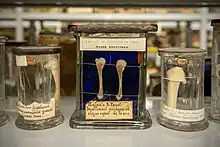 Décollement épiphysaire chez un enfant de 10 ans atteint de la maladie de Parrot.