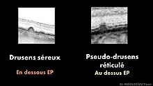 Coupe OCT drusens séreux et pseudo-réticulés