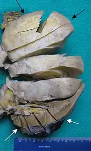 Volumineuse pièce anatomique découpée.