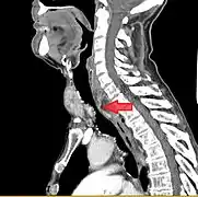 Coupe en noir et blanc d'une de partie de colonne vertébrale. La flèche rouge désigne un rétrécissement dans la trachée.