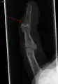 Radiographie montrant une fracture à l'insertion du tendon extenseur