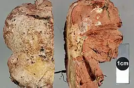 Hôte parasité par Mycogone rosea coupé en deux, vue externe et interne (Nouvelle-Zélande).