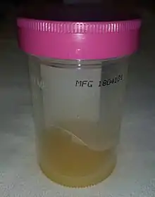 Exemple de liquide d'épanchement prélevé sur un genou infecté.